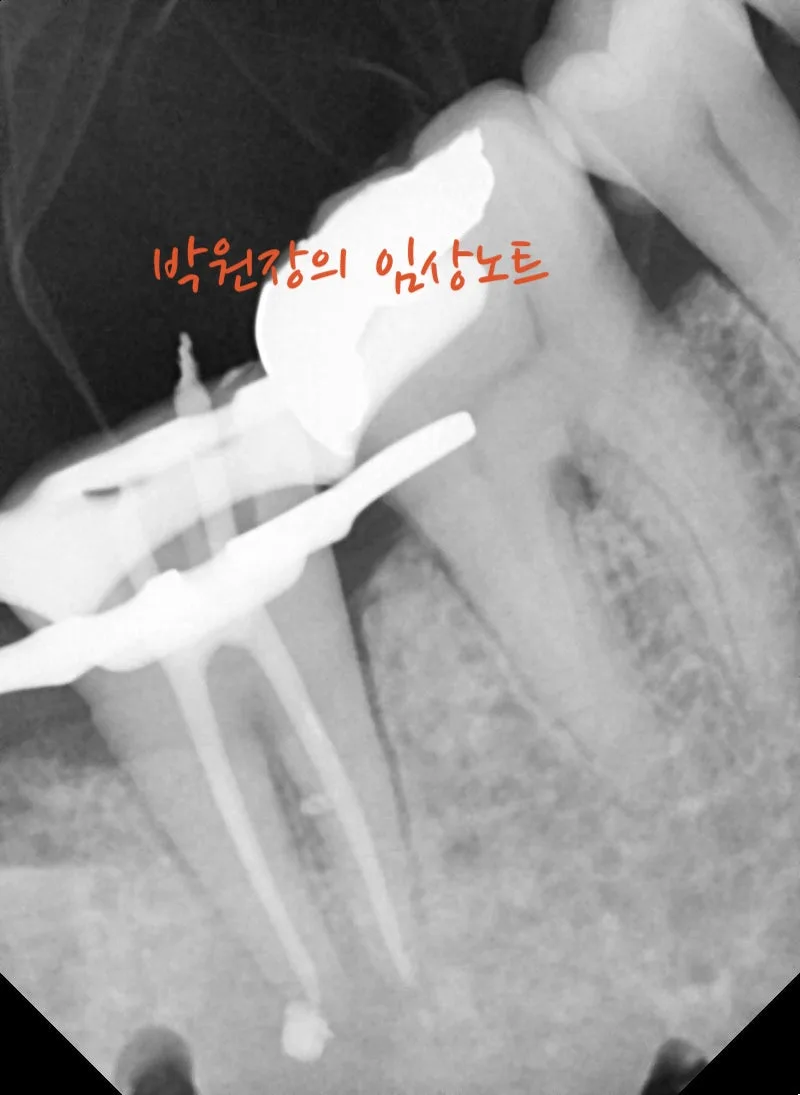 치근단 염증의 변화 임상 자료 10