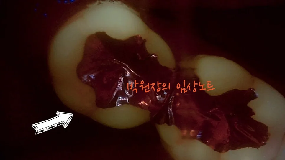 치근단 염증의 변화 임상 자료 6