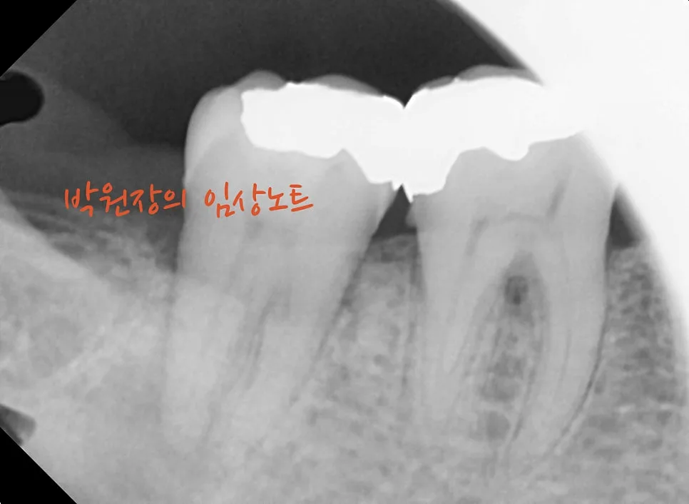 치근단 염증의 변화 임상 자료 8