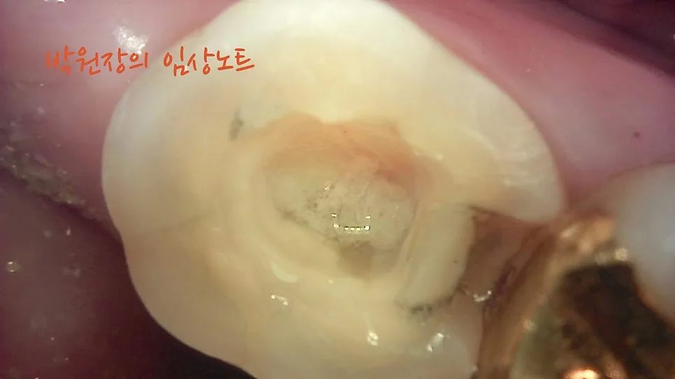 치근단 염증의 변화 임상 자료 9