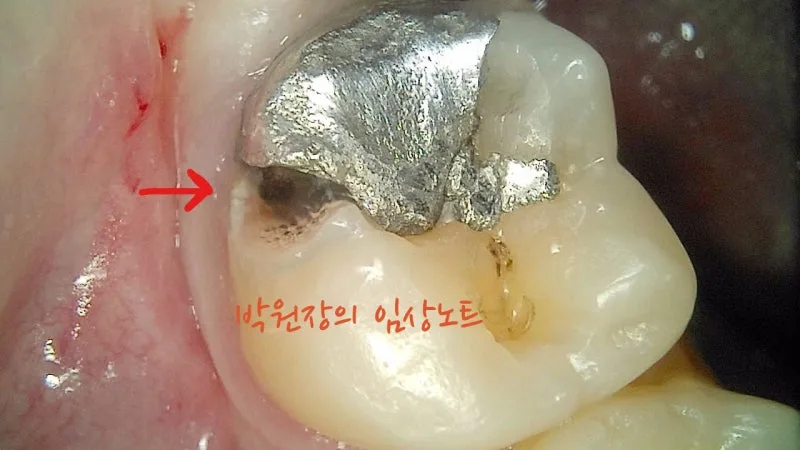 세라믹 인레이 임상 자료 2