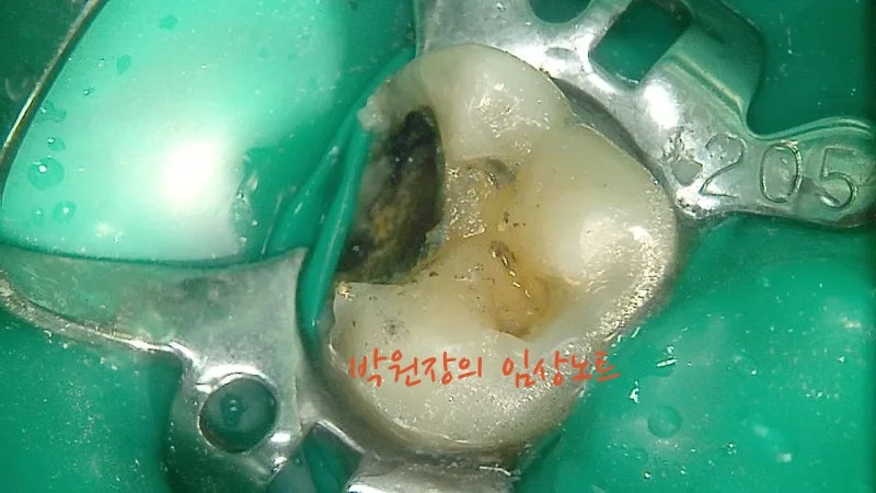 세라믹 인레이 임상 자료 3