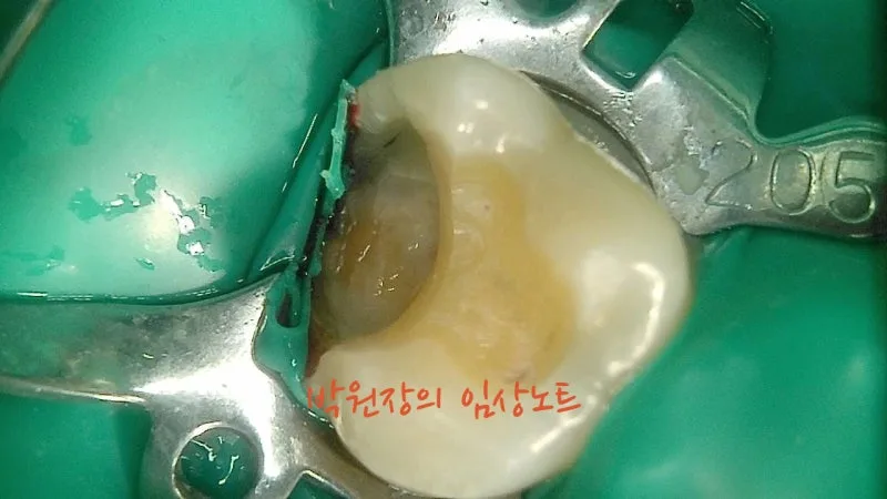 세라믹 인레이 임상 자료 4