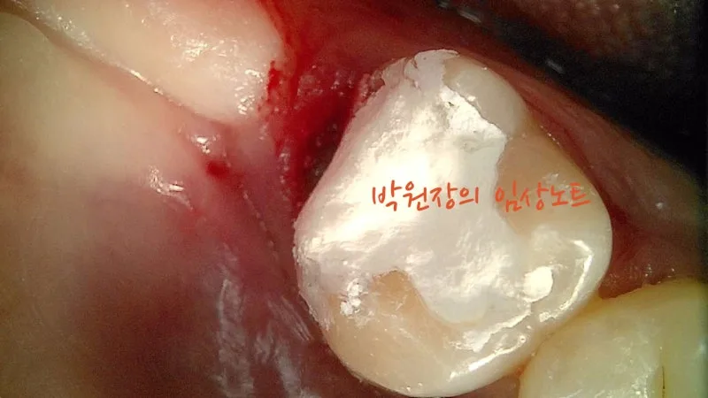 세라믹 인레이 임상 자료 5