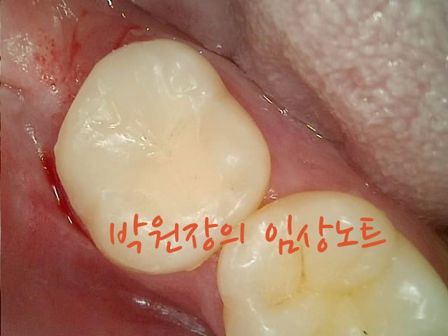 세라믹 인레이 임상 자료 6
