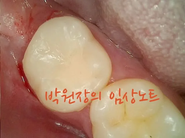 세라믹 인레이 임상 자료 6