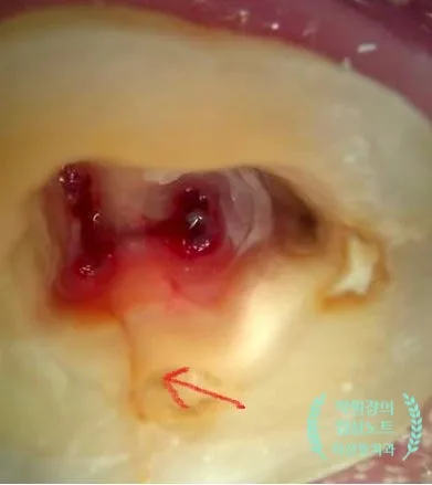 크랙치아 치료 임상 자료 5