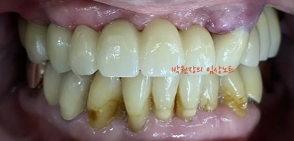 잔존골 부족 네비게이션 임플란트 임상 자료 9