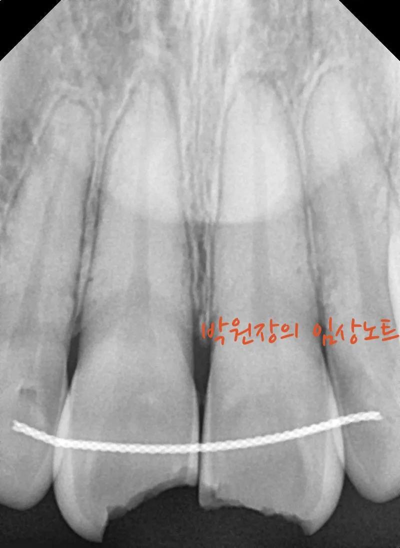 앞니 파절 치료 임상 자료 2