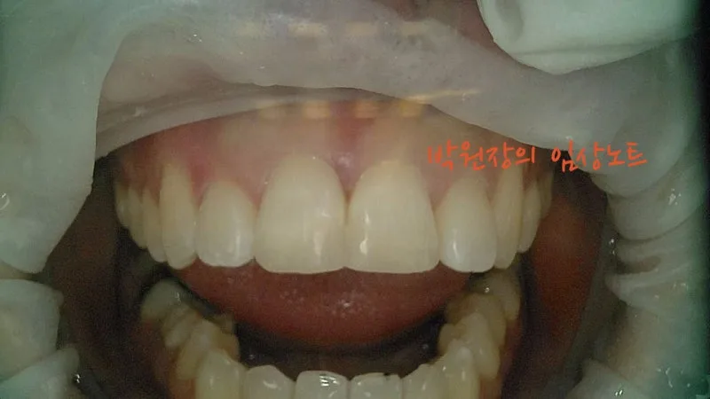 앞니 파절 치료 임상 자료 3