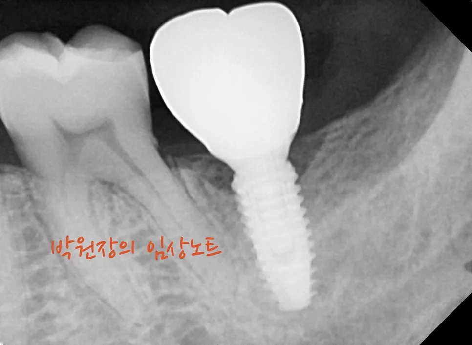 흔들리는 임플란트 재치료 임상 자료 3