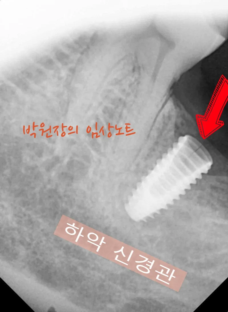 흔들리는 임플란트 재치료 임상 자료 4