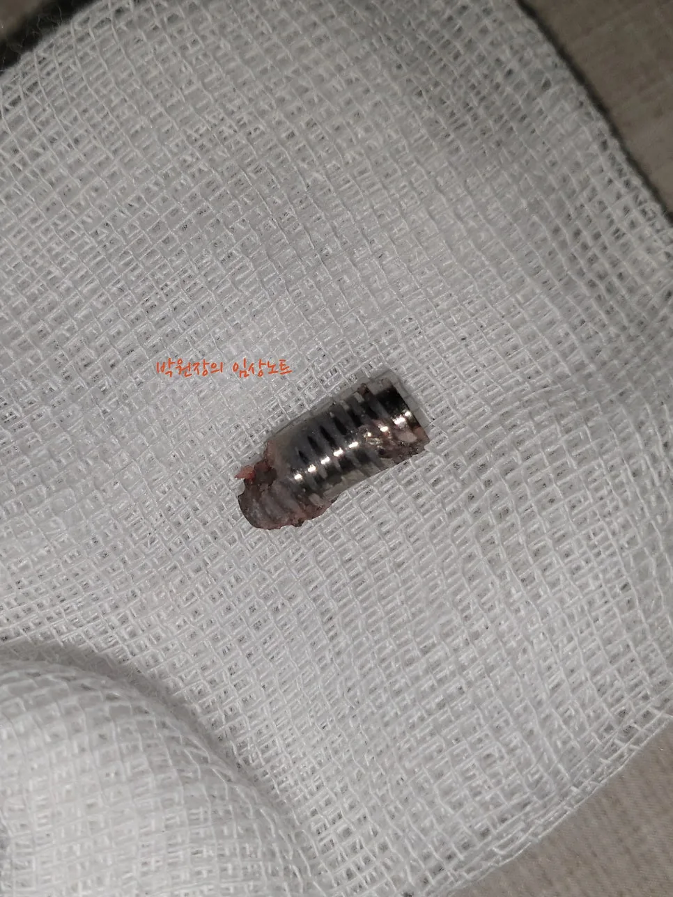 흔들리는 임플란트 재치료 임상 자료 5