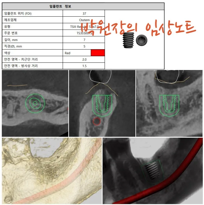 흔들리는 임플란트 재치료 임상 자료 8