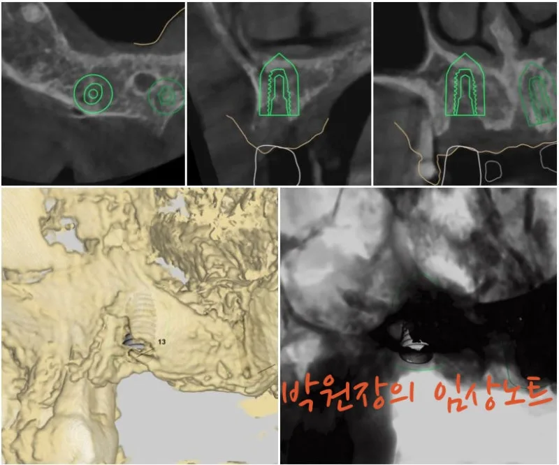네비게이션 임플란트 임상 자료 4