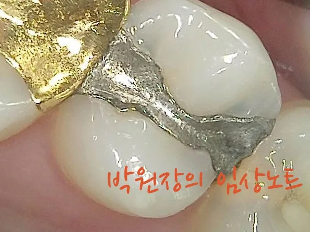 아말감 하방 충치 증례 대표 자료