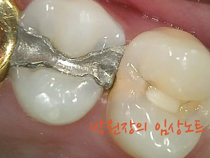 아말감 하방 충치 임상 자료 2