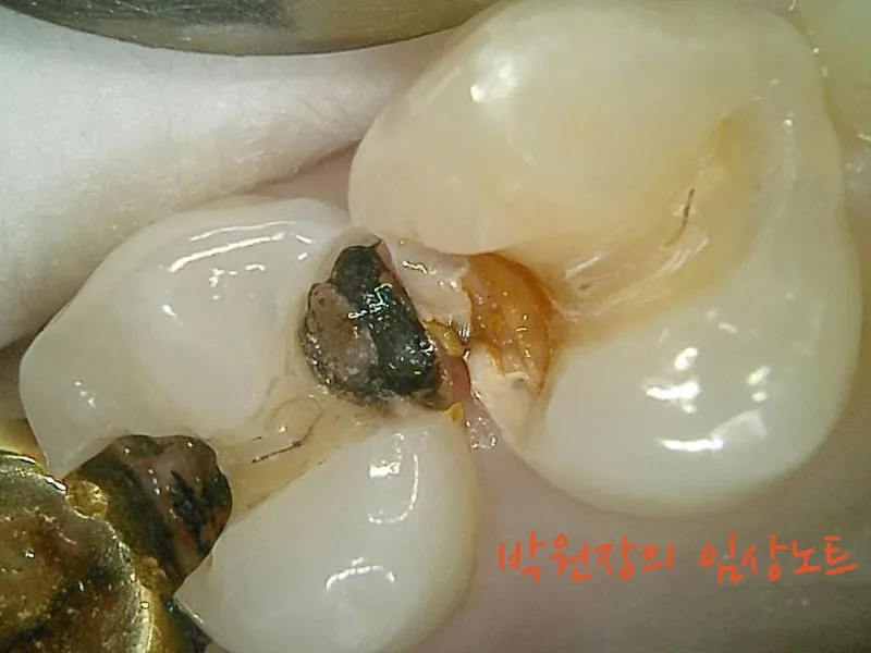 아말감 하방 충치 임상 자료 3