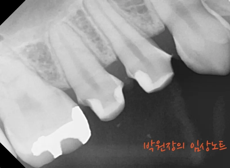 아말감 하방 충치 임상 자료 6