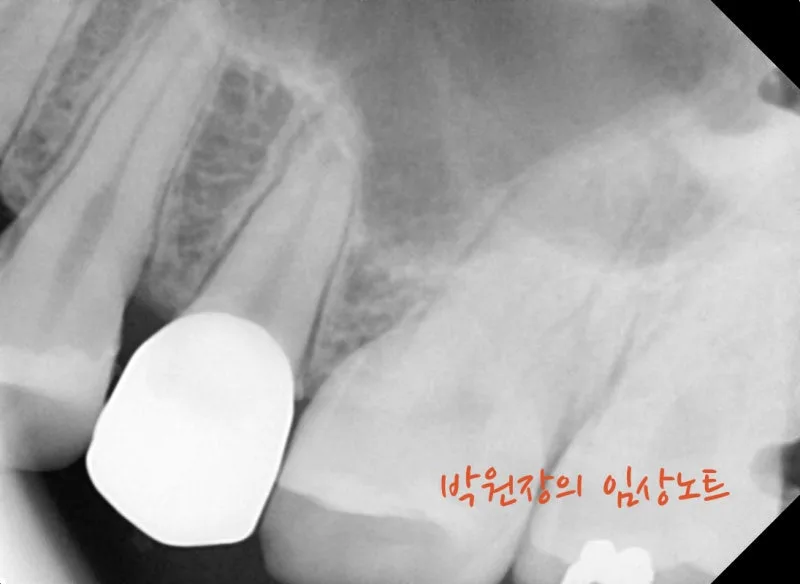 아말감 하방 충치 임상 자료 8