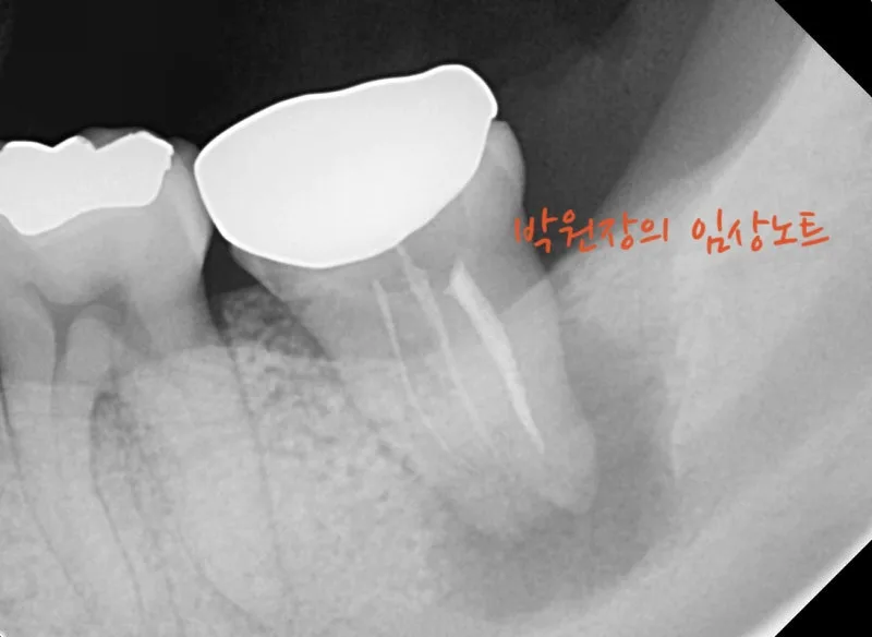재근관치료 임상 자료 2