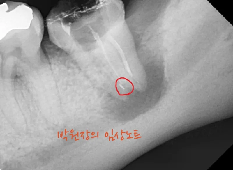 재근관치료 임상 자료 3