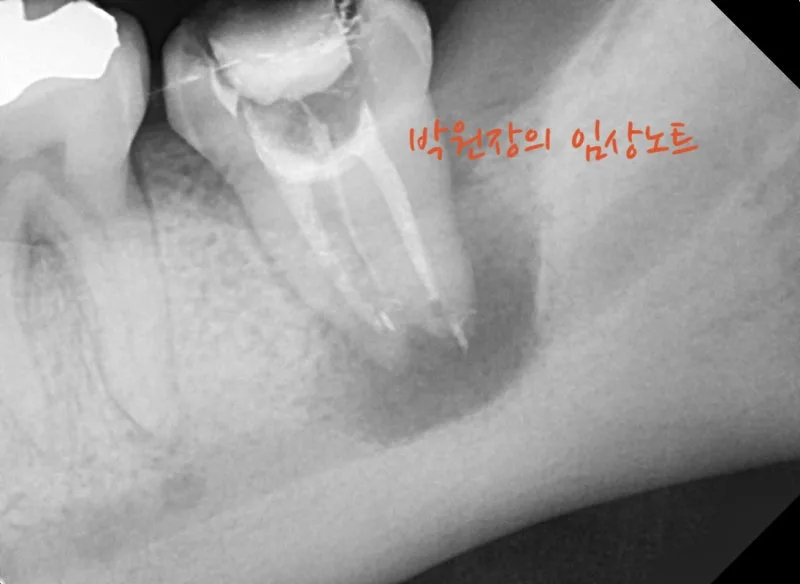 재근관치료 임상 자료 4
