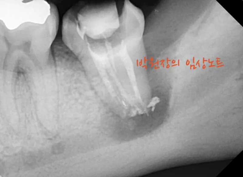 재근관치료 임상 자료 6