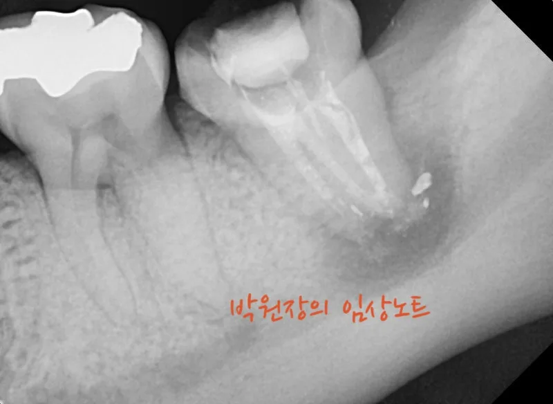 재근관치료 임상 자료 7