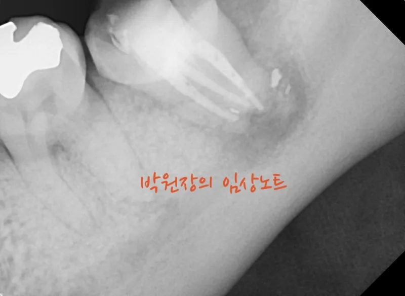 재근관치료 임상 자료 8