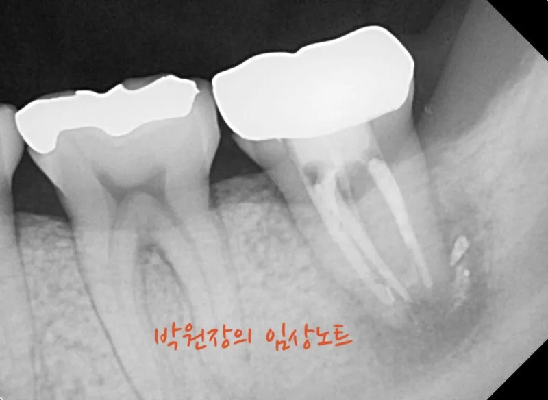 재근관치료 임상 자료 9