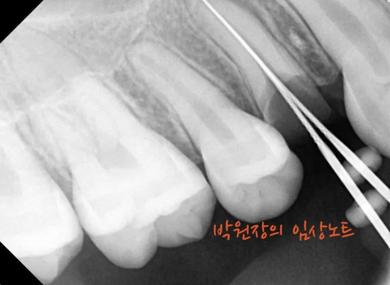 뿌리만 남은 치아 보존 임상 자료 3