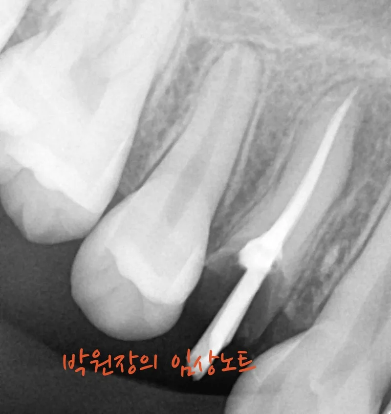 뿌리만 남은 치아 보존 임상 자료 4