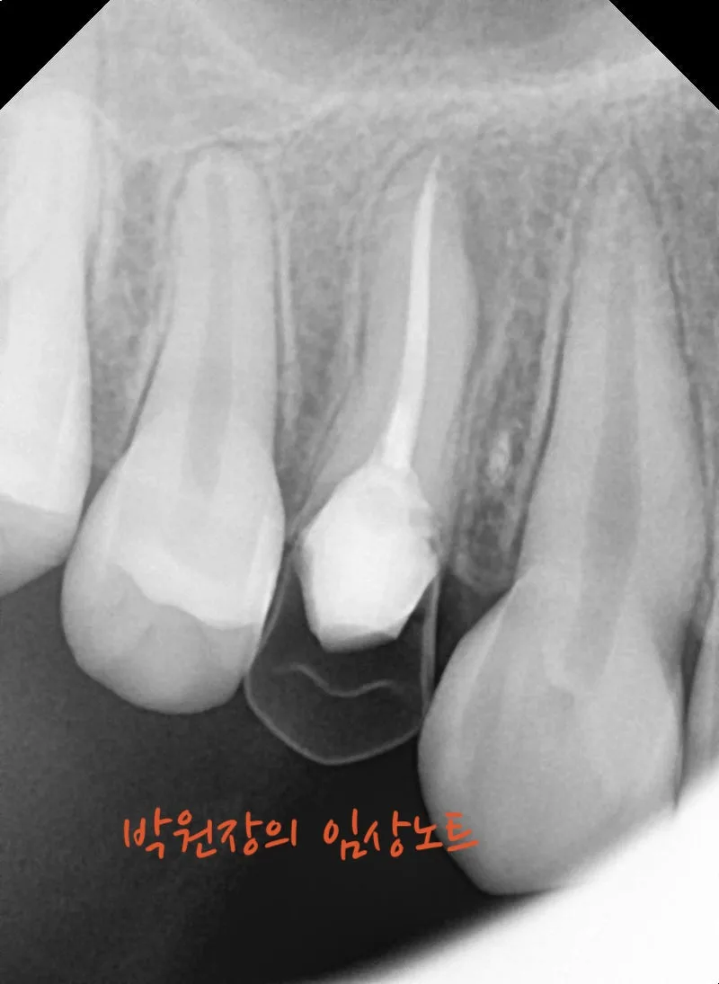 뿌리만 남은 치아 보존 임상 자료 6