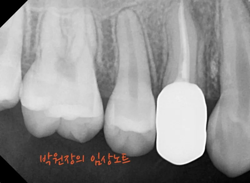 뿌리만 남은 치아 보존 임상 자료 7