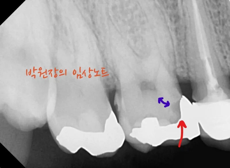 수복물 내부 충치 임상 자료 2