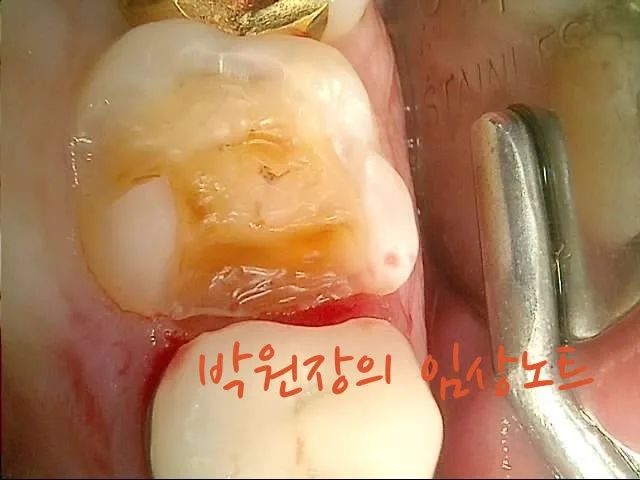 수복물 내부 충치 임상 자료 4