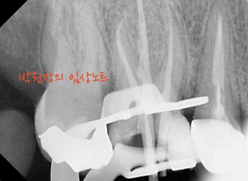 수복물 내부 충치 임상 자료 5