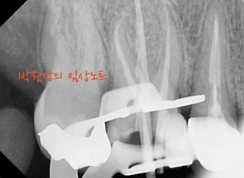 수복물 내부 충치 임상 자료 5