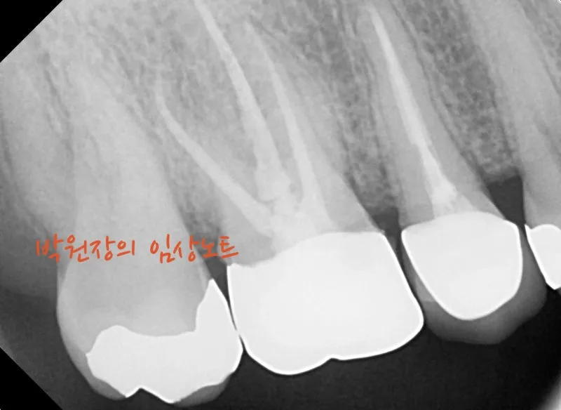 수복물 내부 충치 임상 자료 6