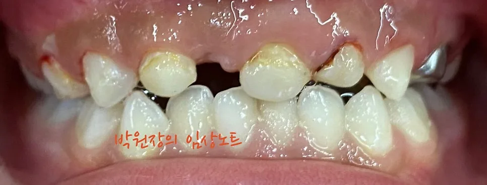 다발성 소아 충치치료 임상 자료 11