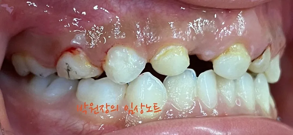 다발성 소아 충치치료 임상 자료 12