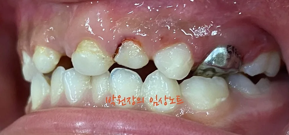 다발성 소아 충치치료 임상 자료 13