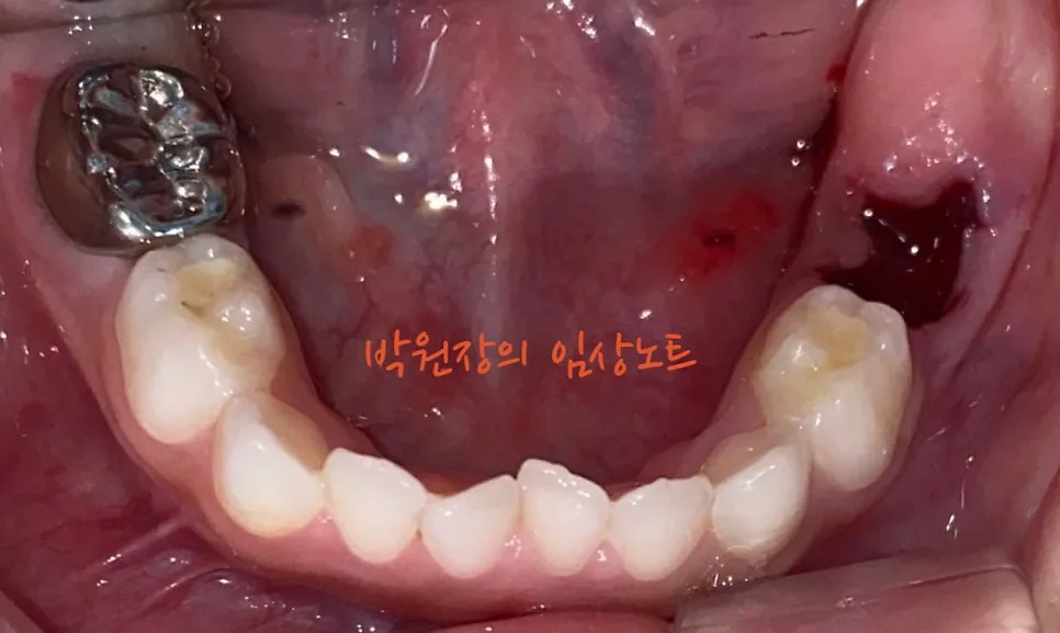 다발성 소아 충치치료 임상 자료 14