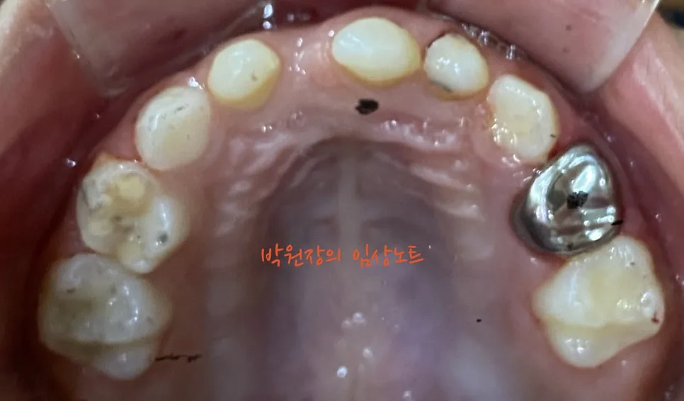다발성 소아 충치치료 임상 자료 15