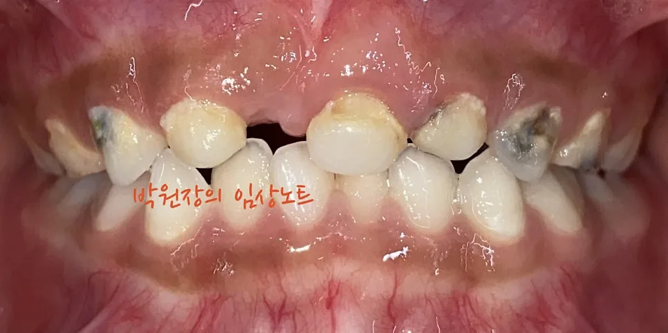 다발성 소아 충치치료 임상 자료 2