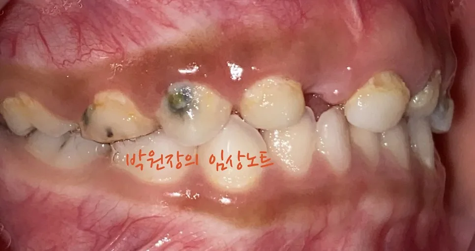 다발성 소아 충치치료 임상 자료 3