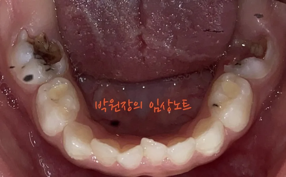 다발성 소아 충치치료 임상 자료 5