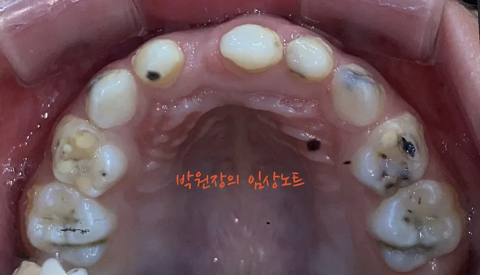 다발성 소아 충치치료 임상 자료 6