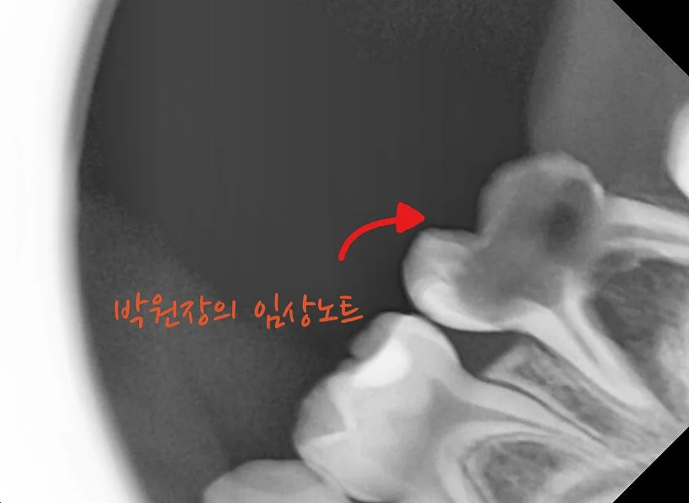 다발성 소아 충치치료 임상 자료 9